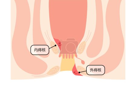 Diseases of the anus, hemorrhoids and warts Illustrations, cross-sectional views - Translation: Internal hemorrhoid nuclei, external hemorrhoid nuclei