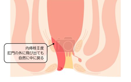Illustration for Diseases of the anus, hemorrhoids and warts "Internal hemorrhoids, degree II" Illustration, cross-sectional view - Translation: Internal hemorrhoids, degree II, If it pops out of the anus, it spontaneously returns inside - Royalty Free Image