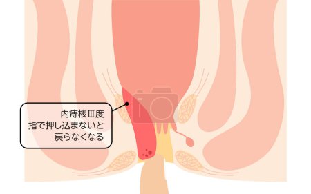 Diseases of the anus, hemorrhoids and warts "Internal hemorrhoids, degree III" Illustration, cross-sectional view - Translation: Internal hemorrhoids, degree III, You have to push it in with your finger to get it back