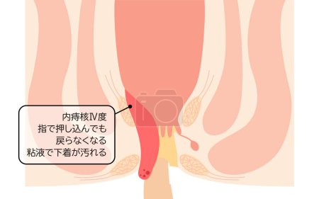 Diseases of the anus, hemorrhoids and warts "Internal hemorrhoids, degree IV" Illustration, cross-sectional view - Translation: Internal hemorrhoids, degree IV, Cannot be pushed back in with fingers, mucus stains underwear