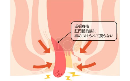 Illustration for Diseases of the anus, hemorrhoids and warts "Fitting hemorrhoids" Illustration, cross-sectional view - Translation: Inserted hemorrhoids, Tightened by the anal sphincter muscle and does not return - Royalty Free Image