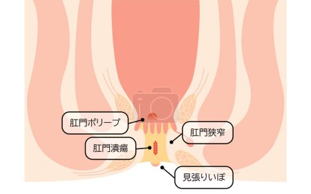 Diseases of the anus, hemorrhoids "anal ulcer, anal stenosis, anal polyp" Illustration, cross-sectional view - Translation: anal ulcer, anal stenosis, anal polyp, lookout warts
