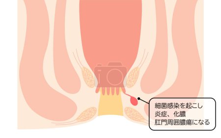 Diseases of the anus, hemorrhoids "Anorectal hemorrhoids" Illustration, cross-sectional view - Translation: Bacterial infection leads to inflammation, possible perianal abscess