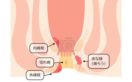 Illustration for Diseases of the anus, hemorrhoids, warts, cut hemorrhoids, anorectal hemorrhoids Illustration, cross-sectional view - Translation: hemorrhoids, warts, cut hemorrhoids, anorectal hemorrhoids - Royalty Free Image