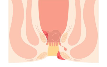 Illustration for Diseases of the anus, hemorrhoids and warts Illustrations, cross-sectional views, Vector Illustration - Royalty Free Image