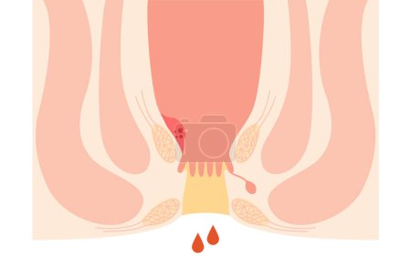 Ilustración de Diseases of the anus, hemorrhoids and warts "Internal hemorrhoids, degree I" Illustration, cross-sectional view, Vector Illustration - Imagen libre de derechos