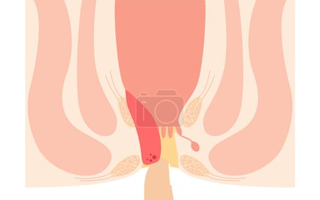 Diseases of the anus, hemorrhoids and warts "Internal hemorrhoids, degree III" Illustration, cross-sectional view, Vector Illustration