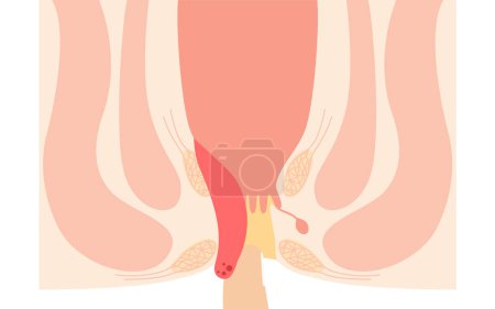 Ilustración de Diseases of the anus, hemorrhoids and warts "Internal hemorrhoids, degree IV" Illustration, cross-sectional view, Vector Illustration - Imagen libre de derechos