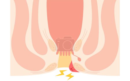 Ilustración de Diseases of the anus, hemorrhoids and warts "Thrombosed external hemorrhoids" Illustration, cross-sectional view, Vector Illustration - Imagen libre de derechos