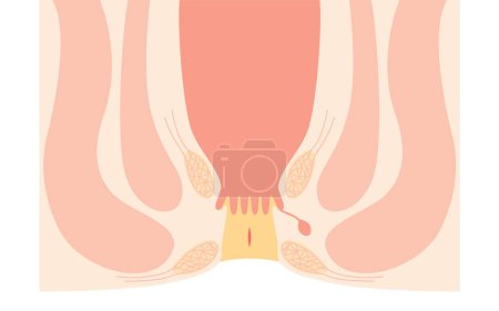 Illustration for Diseases of the anus, hemorrhoids "anal fissures" Illustration, cross-sectional view, Vector Illustration - Royalty Free Image