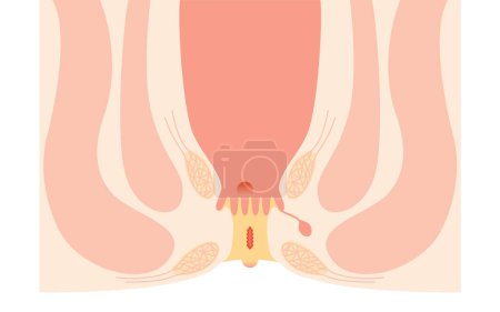 Illustration for Diseases of the anus, hemorrhoids "anal ulcer, anal stenosis, anal polyp" Illustration, cross-sectional view, Vector Illustration - Royalty Free Image