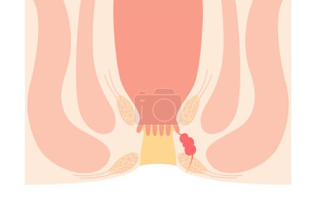 Illustration for Diseases of the anus, hemorrhoids "Anorectal hemorrhoids" Illustration, cross-sectional view, Vector Illustration - Royalty Free Image