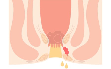 Diseases of the anus, hemorrhoids "Anorectal hemorrhoids" Illustration, cross-sectional view, Vector Illustration