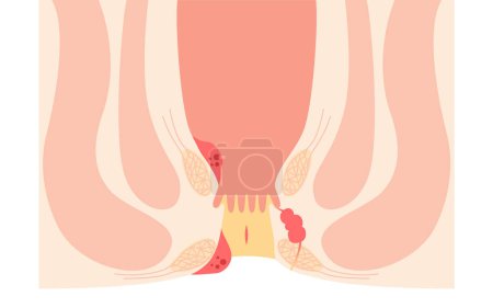 Ilustración de Diseases of the anus, hemorrhoids, warts, cut hemorrhoids, anorectal hemorrhoids Illustration, cross-sectional view, Vector Illustration - Imagen libre de derechos