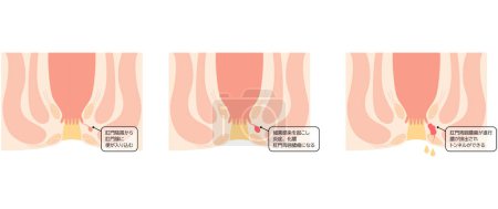 Diseases of the anus, hemorrhoids "Anorectal hemorrhoids" Illustration, cross-sectional view - Translation: Perianal abscess progresses, pus drains and tunnels form