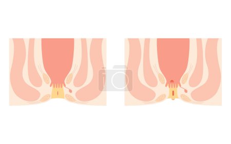 Ilustración de Diseases of the anus, hemorrhoids "anal hemorrhoid, anal ulcer, anal stenosis, anal polyp" Illustration, cross-sectional view, Vector Illustration - Imagen libre de derechos