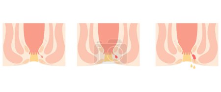 Illustration for Diseases of the anus, hemorrhoids "Anorectal hemorrhoids" Illustration, cross-sectional view, Vector Illustration - Royalty Free Image