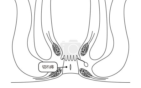 Ilustración de Diseases of the anus, hemorrhoids "anal fissures" Illustration, cross-sectional view - Translation: Cut Hemorrhoids - Imagen libre de derechos