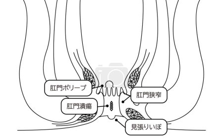 Illustration for Diseases of the anus, hemorrhoids "anal ulcer, anal stenosis, anal polyp" Illustration, cross-sectional view - Translation: anal ulcer, anal stenosis, anal polyp, lookout warts - Royalty Free Image
