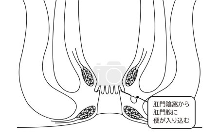 Diseases of the anus, hemorrhoids "Anorectal hemorrhoids" Illustration, cross-sectional view - Translation: Stool enters through the perineal fossa