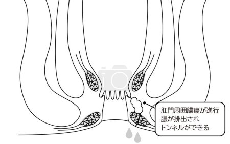 Illustration for Diseases of the anus, hemorrhoids "Anorectal hemorrhoids" Illustration, cross-sectional view - Translation: Perianal abscess progresses, pus drains and tunnels form - Royalty Free Image