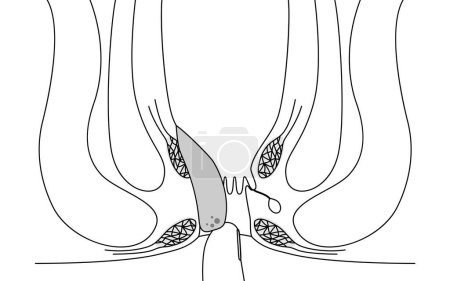 Diseases of the anus, hemorrhoids and warts "Internal hemorrhoids, degree III" Illustration, cross-sectional view, Vector Illustration