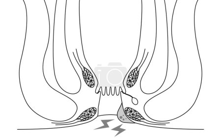 Ilustración de Diseases of the anus, hemorrhoids and warts "Thrombosed external hemorrhoids" Illustration, cross-sectional view, Vector Illustration - Imagen libre de derechos
