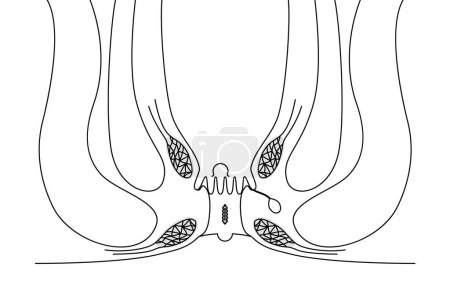 Ilustración de Diseases of the anus, hemorrhoids "anal ulcer, anal stenosis, anal polyp" Illustration, cross-sectional view, Vector Illustration - Imagen libre de derechos