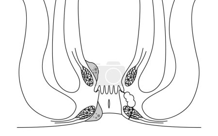Illustration for Diseases of the anus, hemorrhoids, warts, cut hemorrhoids, anorectal hemorrhoids Illustration, cross-sectional view, Vector Illustration - Royalty Free Image