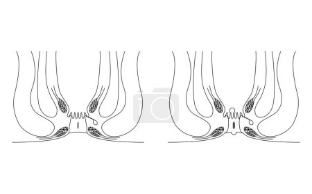Illustration for Diseases of the anus, hemorrhoids "anal hemorrhoid, anal ulcer, anal stenosis, anal polyp" Illustration, cross-sectional view, Vector Illustration - Royalty Free Image
