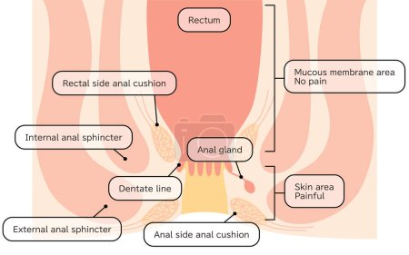 Human body rectum and anus area Illustrations, cross sectional view - Translation: Rectum, anal cushion, sphincter, mucous membrane area, skin area
