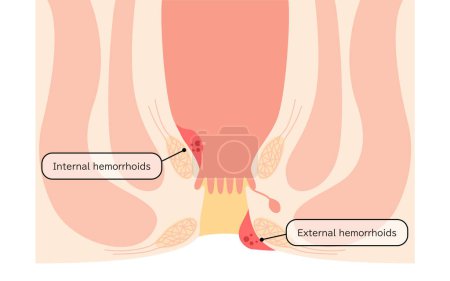 Illustration for Diseases of the anus, hemorrhoids and warts Illustrations, cross-sectional views - Translation: Internal hemorrhoid nuclei, external hemorrhoid nuclei - Royalty Free Image