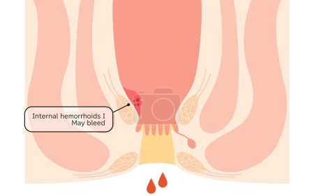 Diseases of the anus, hemorrhoids and warts "Internal hemorrhoids, degree I" Illustration, cross-sectional view - Translation: Internal hemorrhoids, degree I, may bleed
