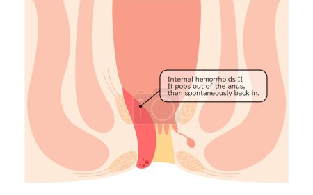 Diseases of the anus, hemorrhoids and warts "Internal hemorrhoids, degree II" Illustration, cross-sectional view - Translation: Internal hemorrhoids, degree II, If it pops out of the anus, it spontaneously returns inside