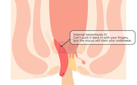 Diseases of the anus, hemorrhoids and warts "Internal hemorrhoids, degree IV" Illustration, cross-sectional view - Translation: Internal hemorrhoids, degree IV, Cannot be pushed back in with fingers, mucus stains underwear