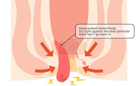 Ilustración de Diseases of the anus, hemorrhoids and warts "Fitting hemorrhoids" Illustration, cross-sectional view - Translation: Inserted hemorrhoids, Tightened by the anal sphincter muscle and does not return - Imagen libre de derechos