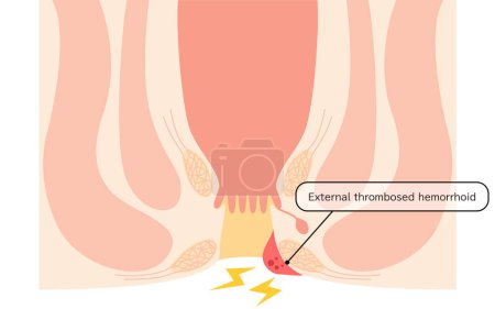 Diseases of the anus, hemorrhoids and warts "Thrombosed external hemorrhoids" Illustration, cross-sectional view - Translation: thrombosed external hemorrhoid nucleus