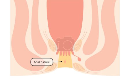 Diseases of the anus, hemorrhoids "anal fissures" Illustration, cross-sectional view - Translation: Cut Hemorrhoids