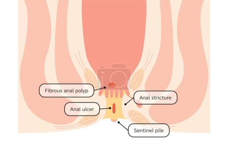 Ilustración de Diseases of the anus, hemorrhoids "anal ulcer, anal stenosis, anal polyp" Illustration, cross-sectional view - Translation: anal ulcer, anal stenosis, anal polyp, lookout warts - Imagen libre de derechos