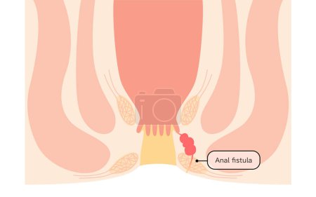 Diseases of the anus, hemorrhoids "Anorectal hemorrhoids" Illustration, cross-sectional view - Translation: Anorectal hemorrhoids