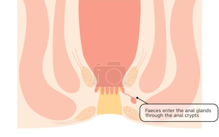 Ilustración de Diseases of the anus, hemorrhoids "Anorectal hemorrhoids" Illustration, cross-sectional view - Translation: Stool enters through the perineal fossa - Imagen libre de derechos