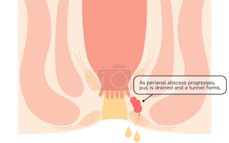 Illustration for Diseases of the anus, hemorrhoids "Anorectal hemorrhoids" Illustration, cross-sectional view - Translation: Perianal abscess progresses, pus drains and tunnels form - Royalty Free Image