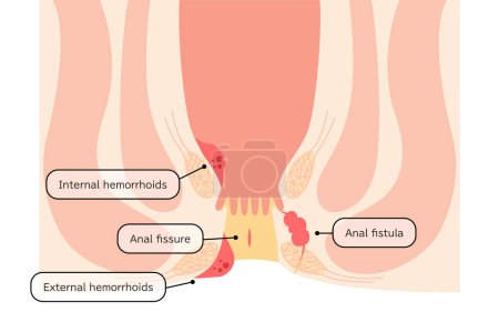 Ilustración de Diseases of the anus, hemorrhoids, warts, cut hemorrhoids, anorectal hemorrhoids Illustration, cross-sectional view - Translation: hemorrhoids, warts, cut hemorrhoids, anorectal hemorrhoids - Imagen libre de derechos