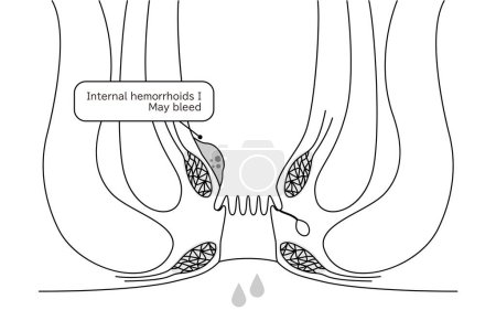 Diseases of the anus, hemorrhoids and warts "Internal hemorrhoids, degree I" Illustration, cross-sectional view - Translation: Internal hemorrhoids, degree I, may bleed