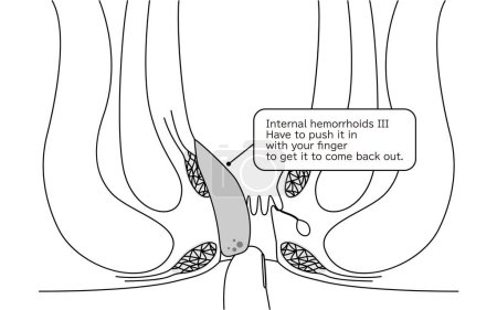 Diseases of the anus, hemorrhoids and warts "Internal hemorrhoids, degree III" Illustration, cross-sectional view - Translation: Internal hemorrhoids, degree III, You have to push it in with your finger to get it back