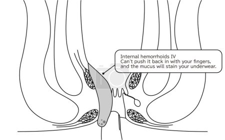 Illustration for Diseases of the anus, hemorrhoids and warts "Internal hemorrhoids, degree IV" Illustration, cross-sectional view - Translation: Internal hemorrhoids, degree IV, Cannot be pushed back in with fingers, mucus stains underwear - Royalty Free Image