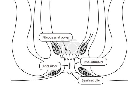 Ilustración de Diseases of the anus, hemorrhoids "anal ulcer, anal stenosis, anal polyp" Illustration, cross-sectional view - Translation: anal ulcer, anal stenosis, anal polyp, lookout warts - Imagen libre de derechos