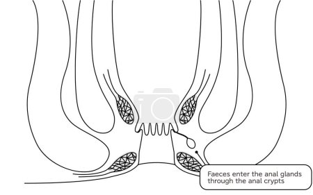 Diseases of the anus, hemorrhoids "Anorectal hemorrhoids" Illustration, cross-sectional view - Translation: Stool enters through the perineal fossa