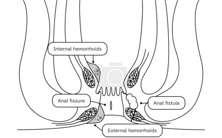 Illustration for Diseases of the anus, hemorrhoids, warts, cut hemorrhoids, anorectal hemorrhoids Illustration, cross-sectional view - Translation: hemorrhoids, warts, cut hemorrhoids, anorectal hemorrhoids - Royalty Free Image