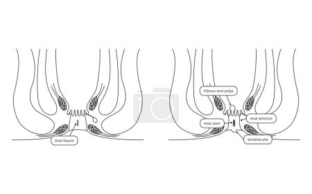 Diseases of the anus, hemorrhoids "anal hemorrhoid, anal ulcer, anal stenosis, anal polyp" Illustration, cross-sectional view - Translation: anal hemorrhoid, anal ulcer, anal stenosis, anal polyp